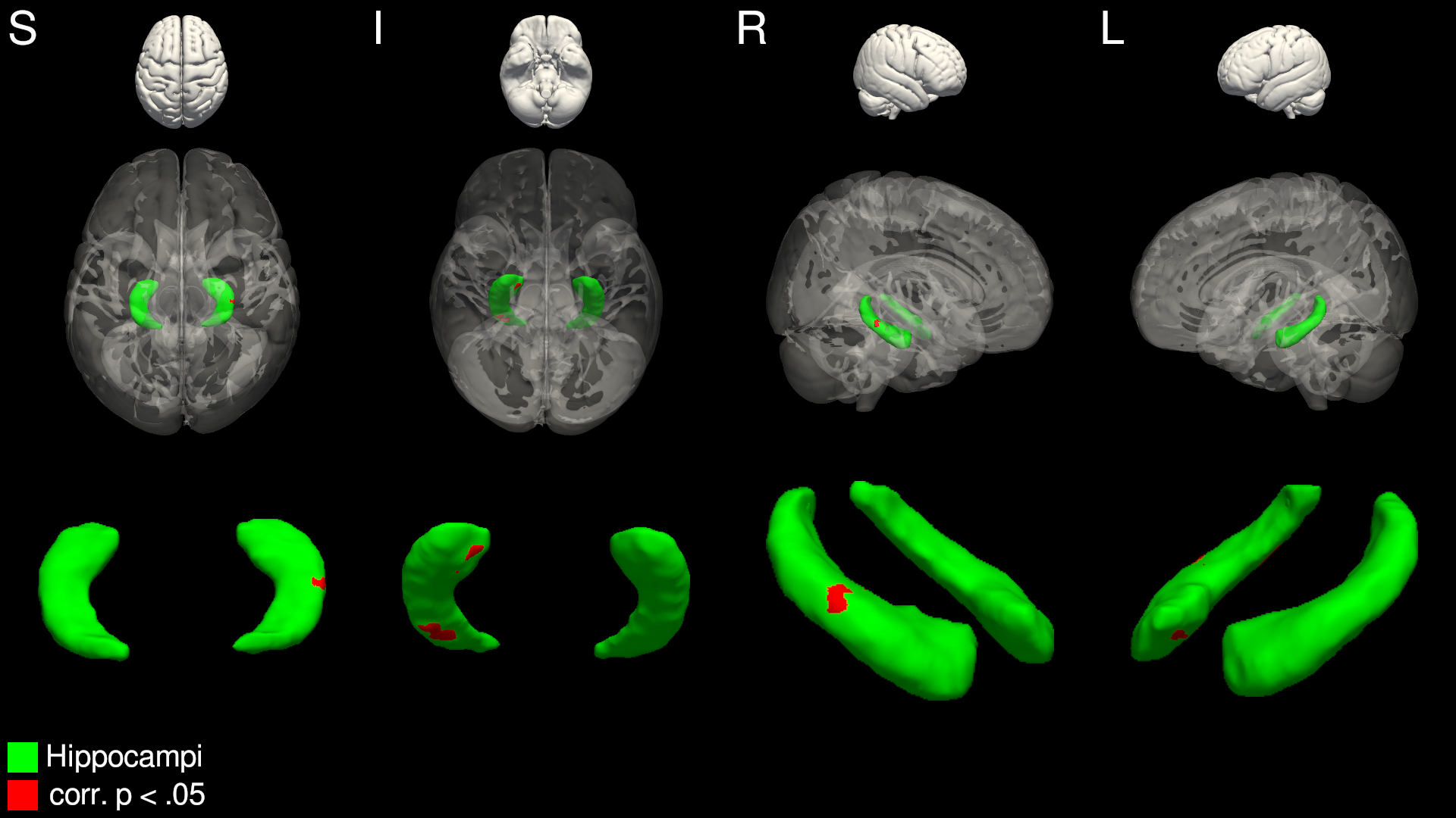 Figure 1. Surface shape analysis results, showing significant inwards deflation of the right hippocampus in the seizure-recurrent group.